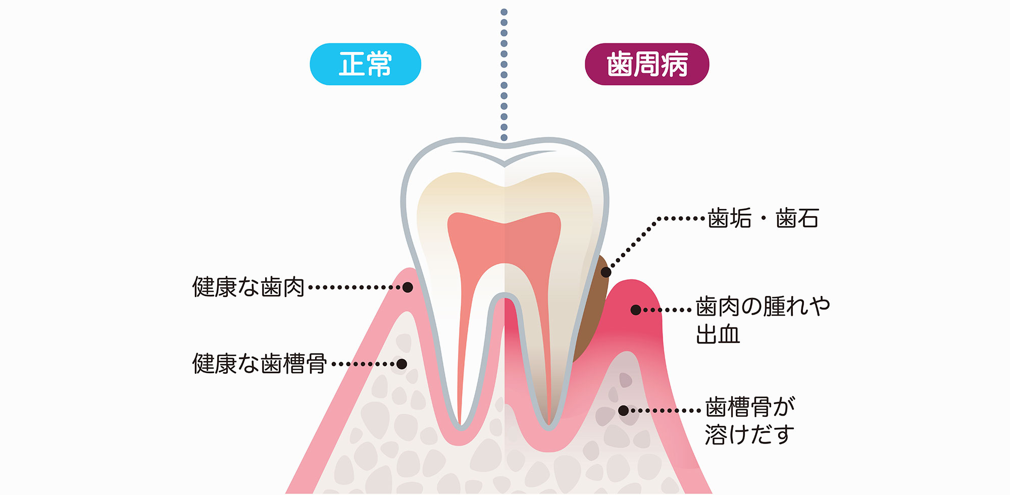 歯周病とは