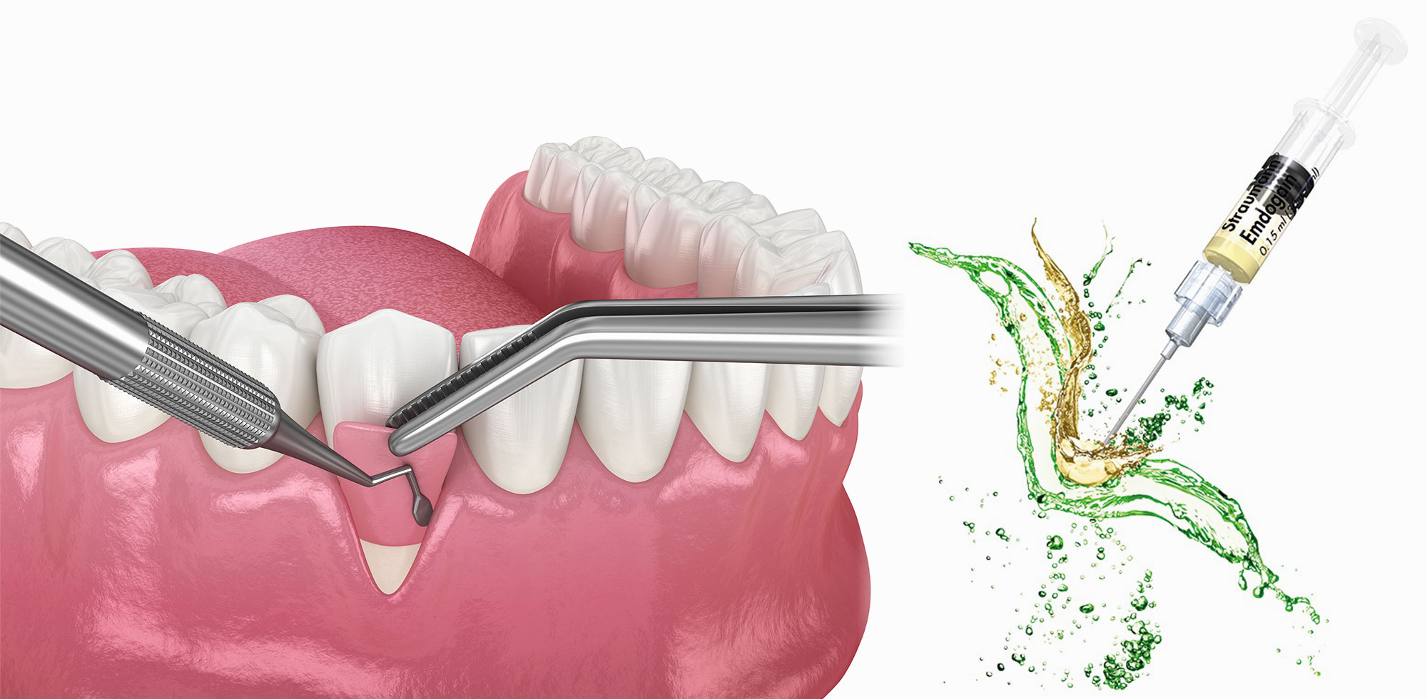 外科的歯周治療・歯周組織再生療法